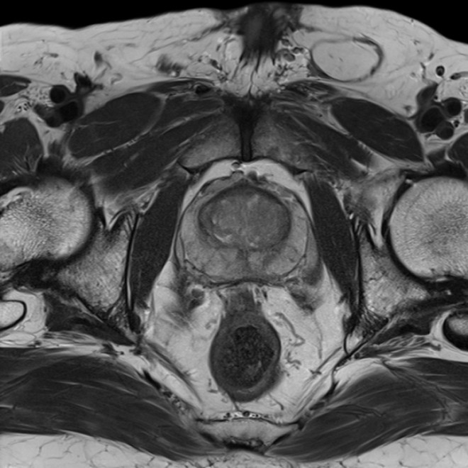 МРТ органов малого таза у мужчин снимок